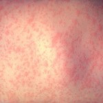 1280px-Morbillivirus_measles_infection
