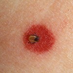 Ticks Still a Big Disease Risk in Galway