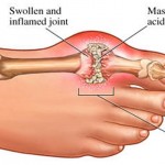 Information on Gout from Claregalway Pharmacy